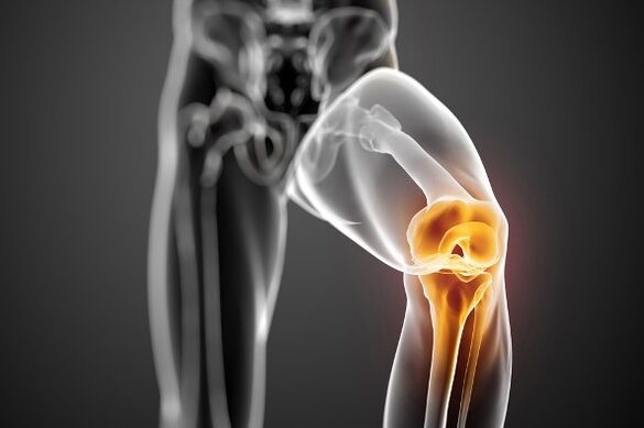 Arthritis of the knee joint