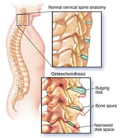cervical osteochondrosis