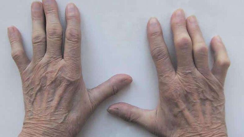 Methods for treating pain in finger joints