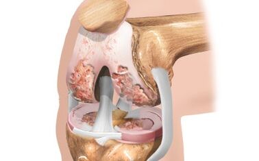 Arthritis of the knee joint