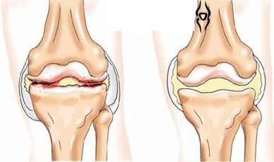 Bilateral gonartrosis
