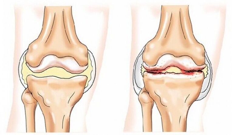 Healthy and joint fusion affected by arthritis