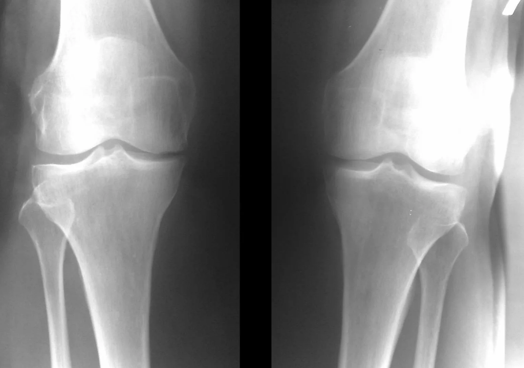 diagnosis of arthrosis of the knee joint