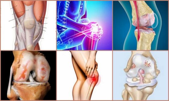 the development of knee arthrosis