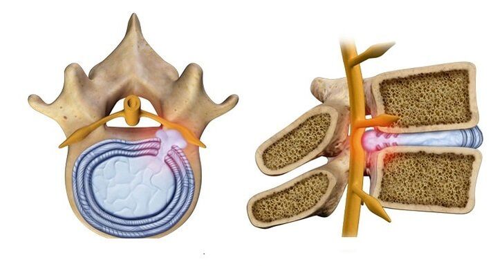 Intervertebral disc herniation – protrusion of the disc nucleus into the spinal canal